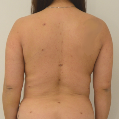 Liposuction Before & After Image