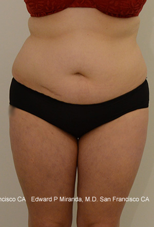 Liposuction Before & After Image