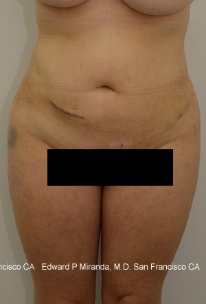 Liposuction Before & After Image