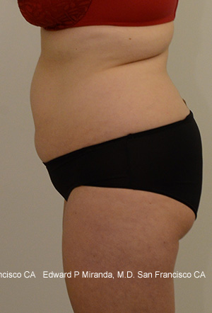 Liposuction Before & After Image