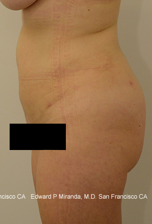 Liposuction Before & After Image