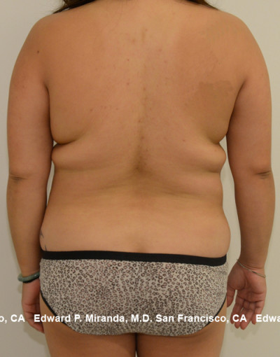 Liposuction Before & After Image