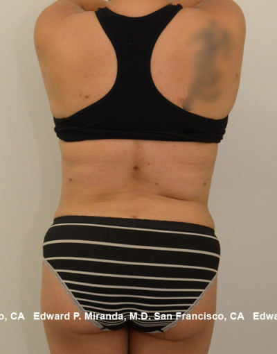 Liposuction Before & After Image