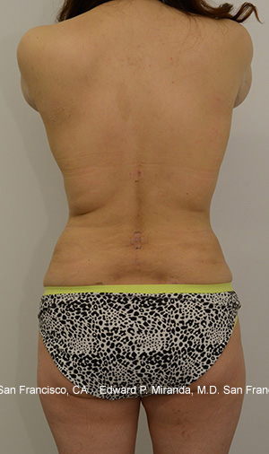 Liposuction Before & After Image