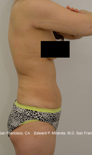 Liposuction Before & After Image