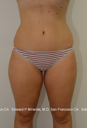 Liposuction Before & After Image