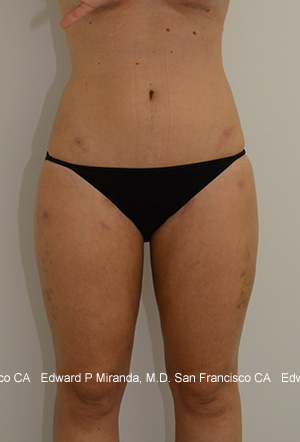 Liposuction Before & After Image