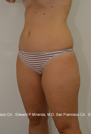 Liposuction Before & After Image