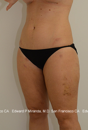 Liposuction Before & After Image