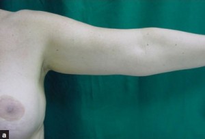 Liposuction Before & After Image