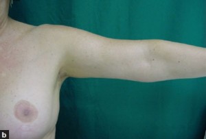 Liposuction Before & After Image