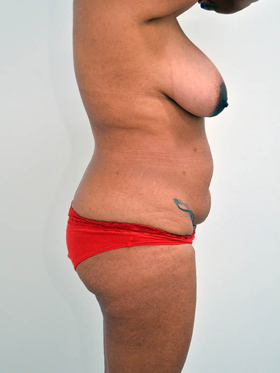 Tummy Tuck Before & After Image