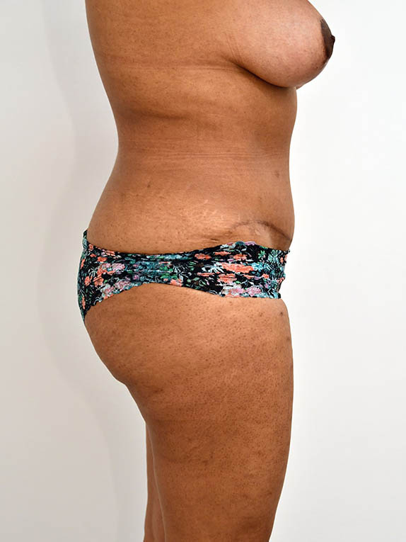 Tummy Tuck Before & After Image