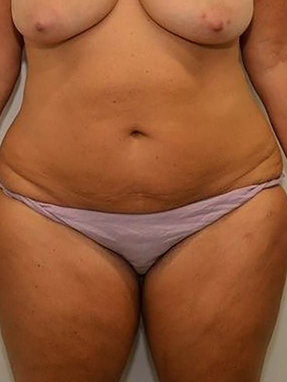 Tummy Tuck Before & After Image