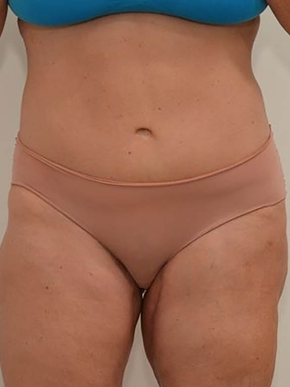 Tummy Tuck Before & After Image