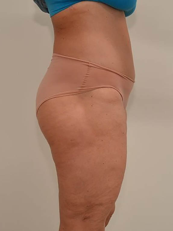 Tummy Tuck Before & After Image