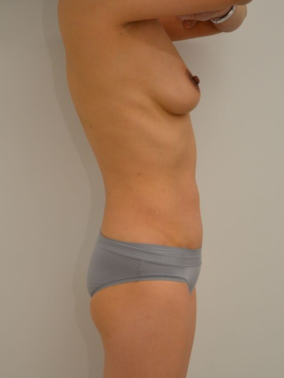 Tummy Tuck Before & After Image