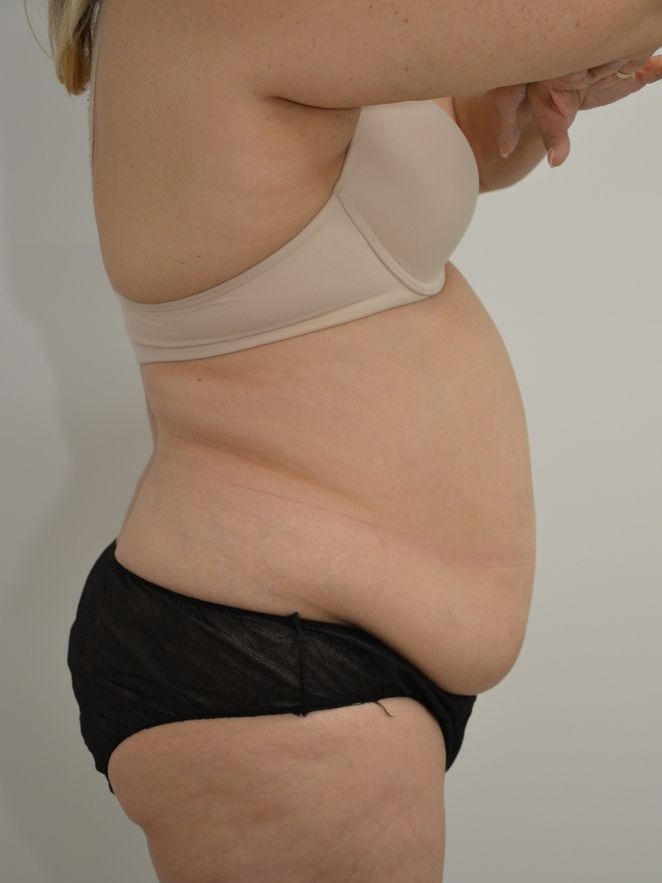 Tummy Tuck Before & After Image