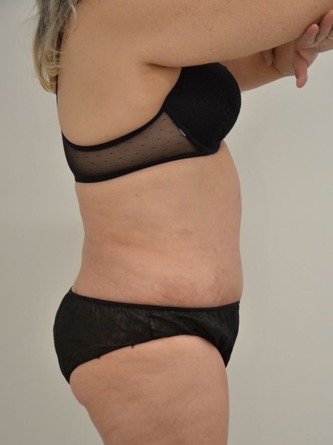 Tummy Tuck Before & After Image