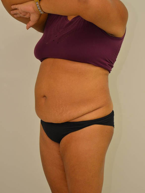 Tummy Tuck Before & After Image