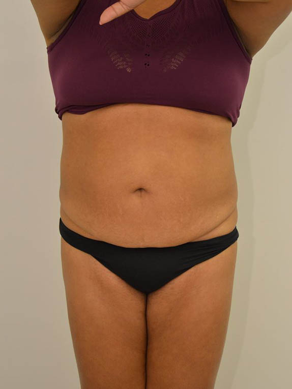 Tummy Tuck Before & After Image