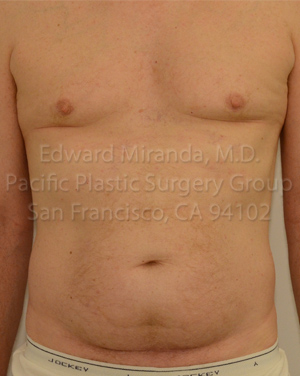 Tummy Tuck Before & After Image