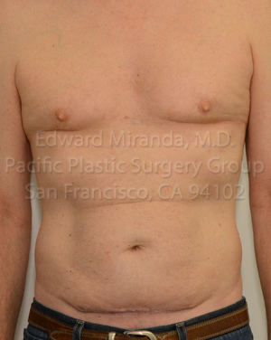 Tummy Tuck Before & After Image