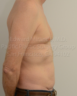 Tummy Tuck Before & After Image