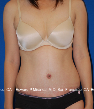 Tummy Tuck Before & After Image