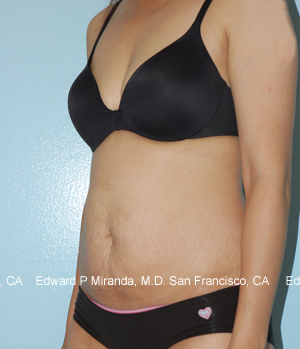 Tummy Tuck Before & After Image