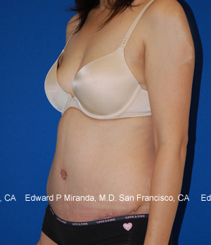 Tummy Tuck Before & After Image