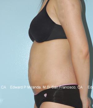 Tummy Tuck Before & After Image