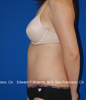 Tummy Tuck Before & After Image