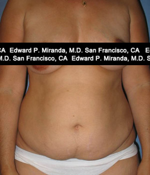 Tummy Tuck Before & After Image