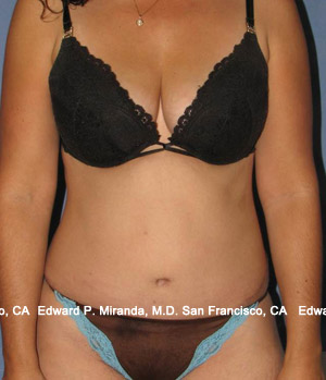 Tummy Tuck Before & After Image