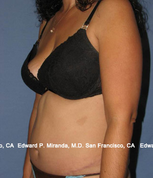 Tummy Tuck Before & After Image