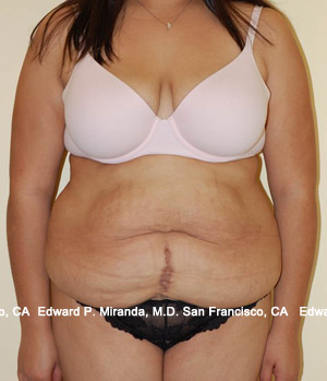 Tummy Tuck Before & After Image