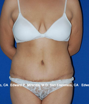 Tummy Tuck Before & After Image