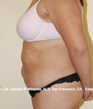 Tummy Tuck Before & After Image