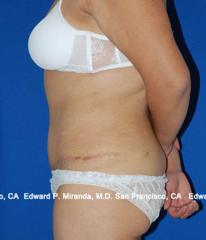 Tummy Tuck Before & After Image