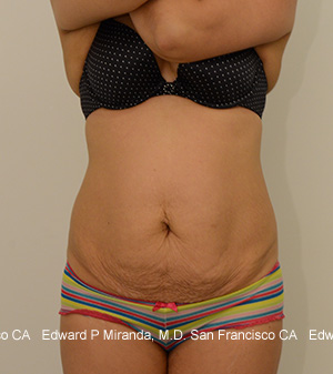 Tummy Tuck Before & After Image