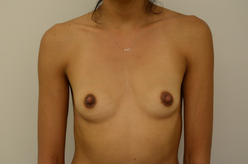 Breast Augmentation Before & After Image