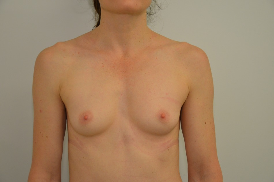 Breast Augmentation Before & After Image