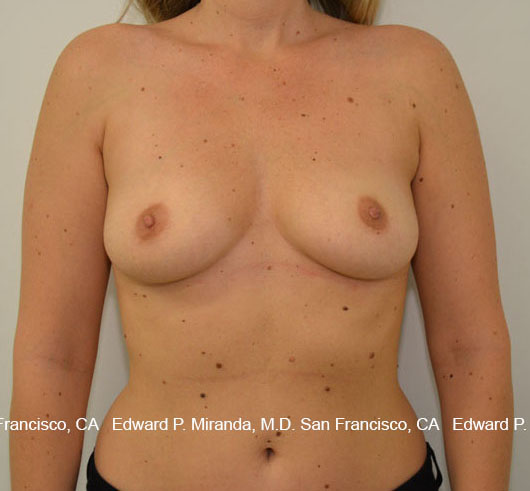 Breast Augmentation Before & After Image