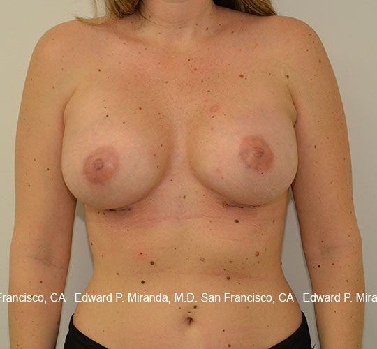 Breast Augmentation Before & After Image