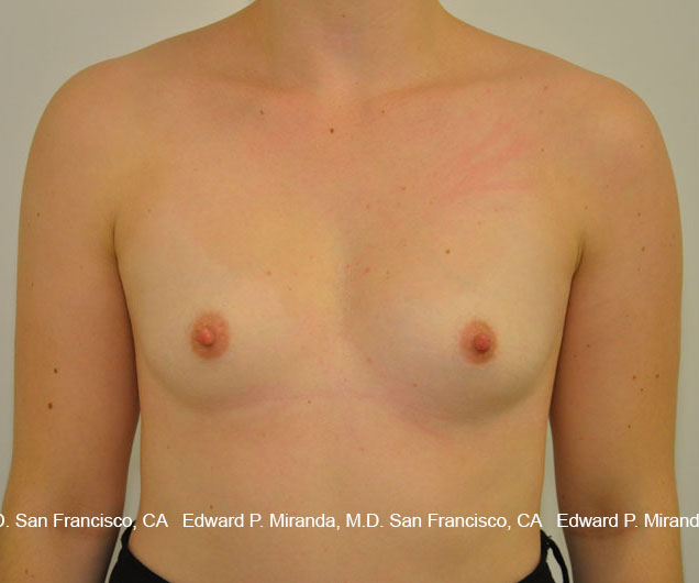 Breast Augmentation Before & After Image