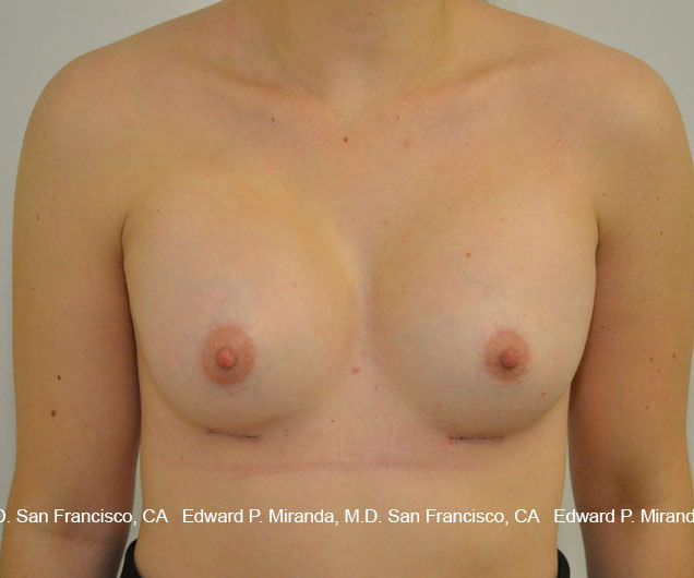 Breast Augmentation Before & After Image