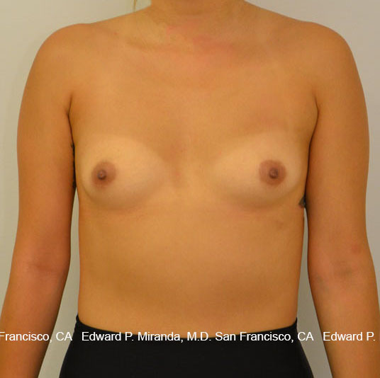 Breast Augmentation Before & After Image