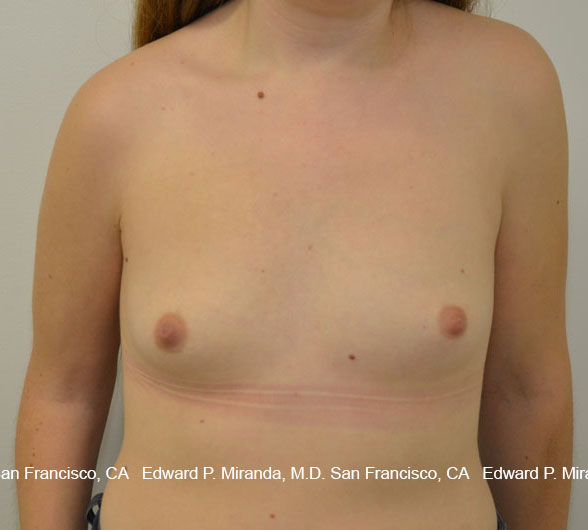 Breast Augmentation Before & After Image