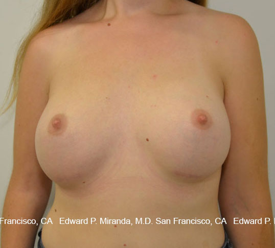 Breast Augmentation Before & After Image